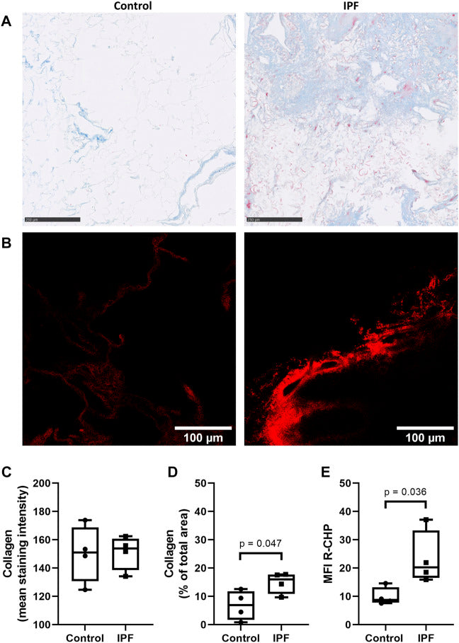 Uncovering Fibrosis: Superior Sensitivity of CHPs in Targeting IPF